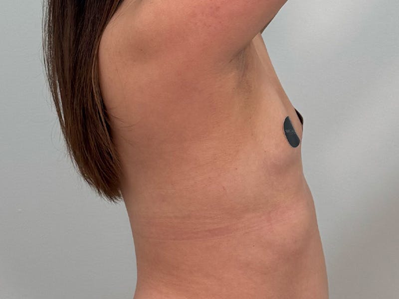 Breast Augmentation Before & After Gallery - Patient 107234 - Image 7