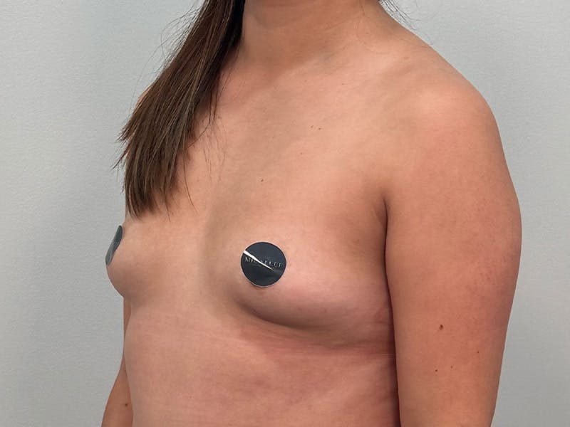 Breast Augmentation Before & After Gallery - Patient 107234 - Image 9