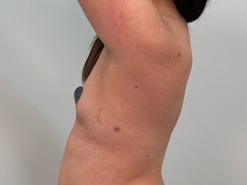 Breast Augmentation Before & After Gallery - Patient 107234 - Image 11