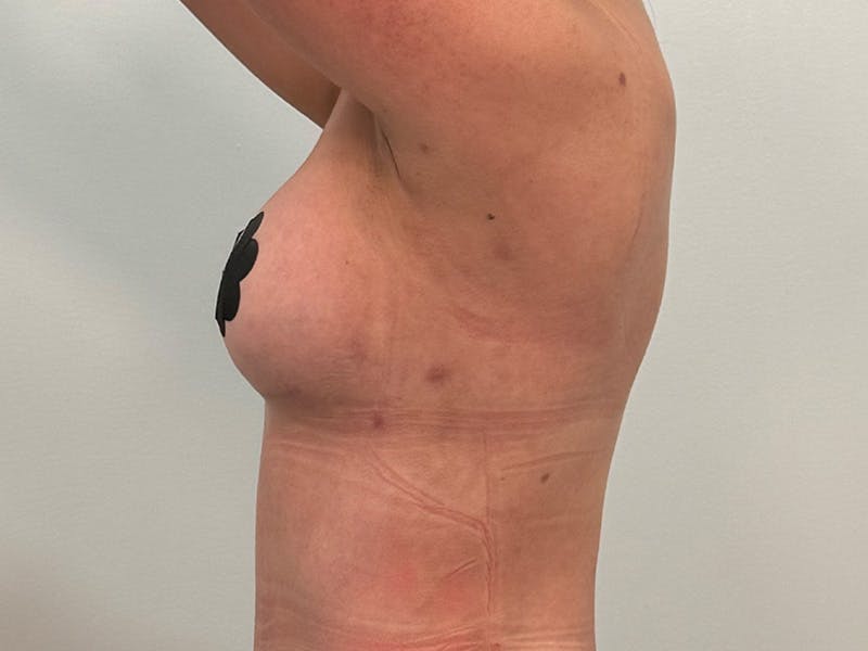 Breast Augmentation Before & After Gallery - Patient 107234 - Image 12