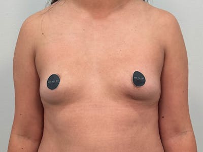 Breast Augmentation Before & After Gallery - Patient 107234 - Image 1