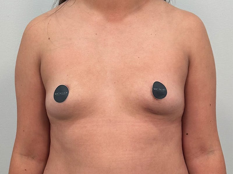 Breast Augmentation Before & After Gallery - Patient 107234 - Image 1