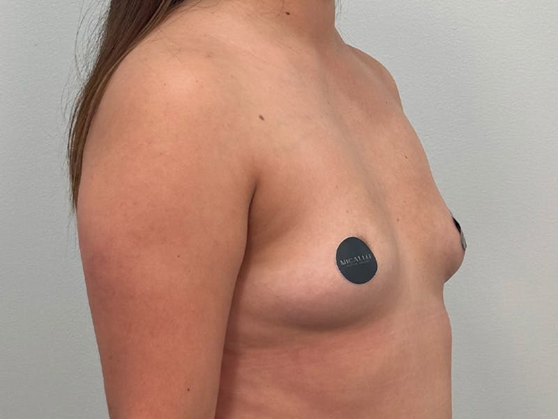 Breast Augmentation Before & After Gallery - Patient 107234 - Image 3