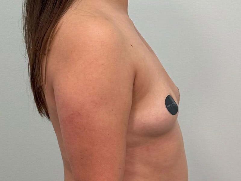 Breast Augmentation Before & After Gallery - Patient 107234 - Image 5