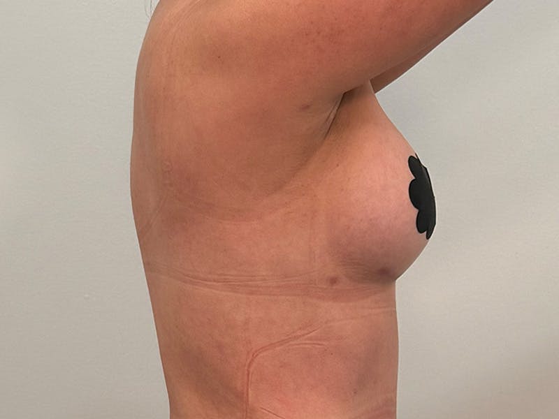 Breast Augmentation Before & After Gallery - Patient 107234 - Image 8