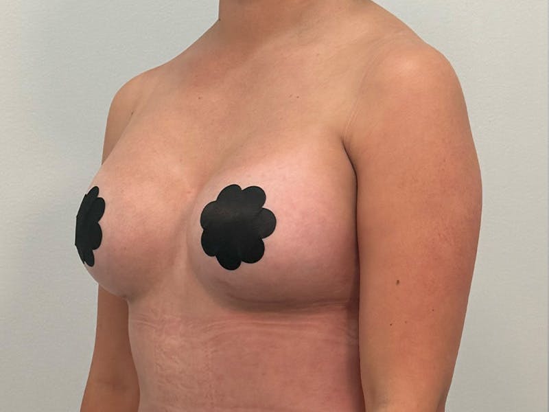 Breast Augmentation Before & After Gallery - Patient 107234 - Image 10
