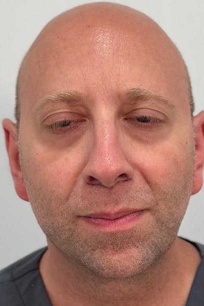 Injectables Before & After Gallery - Patient 235735 - Image 2