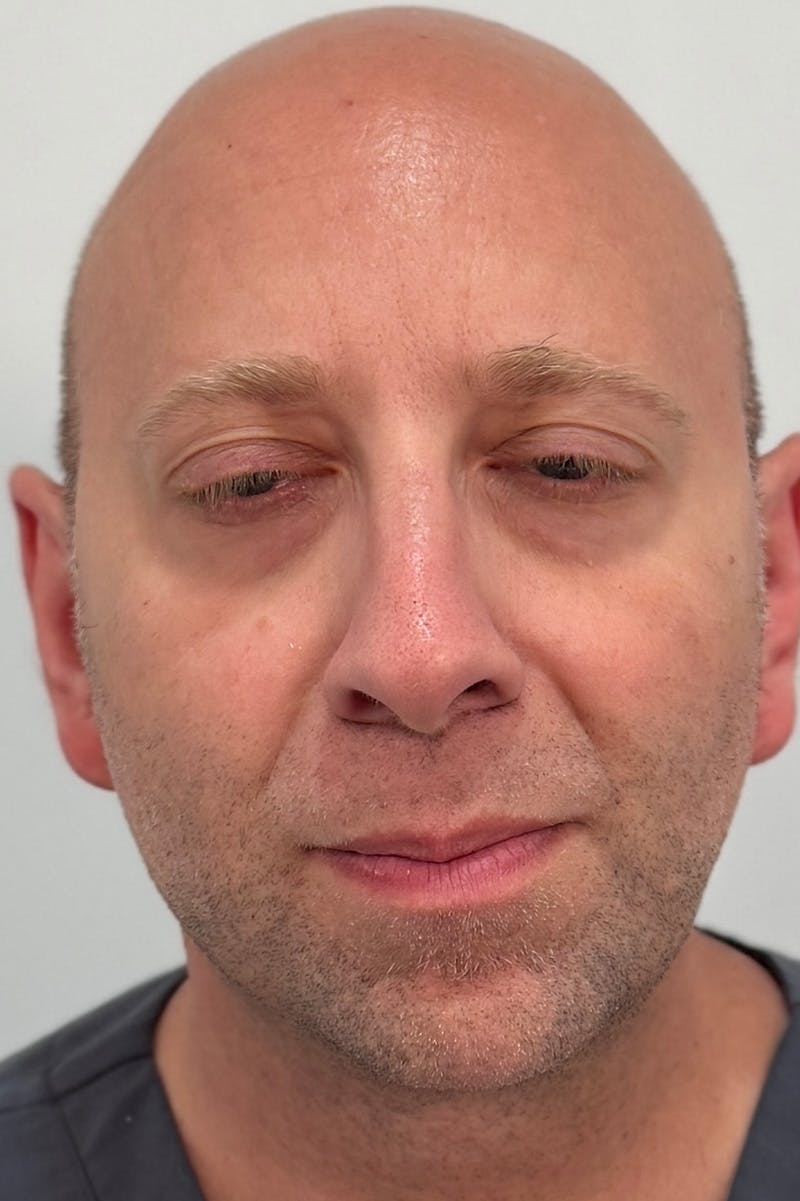 Injectables Before & After Gallery - Patient 235735 - Image 2