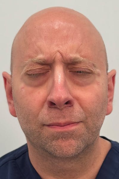Injectables Before & After Gallery - Patient 235735 - Image 1
