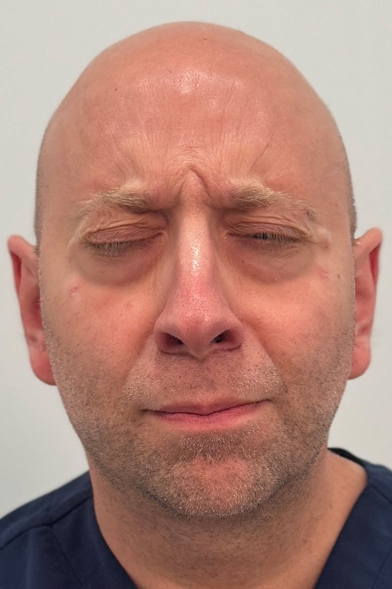 Injectables Before & After Gallery - Patient 235735 - Image 1