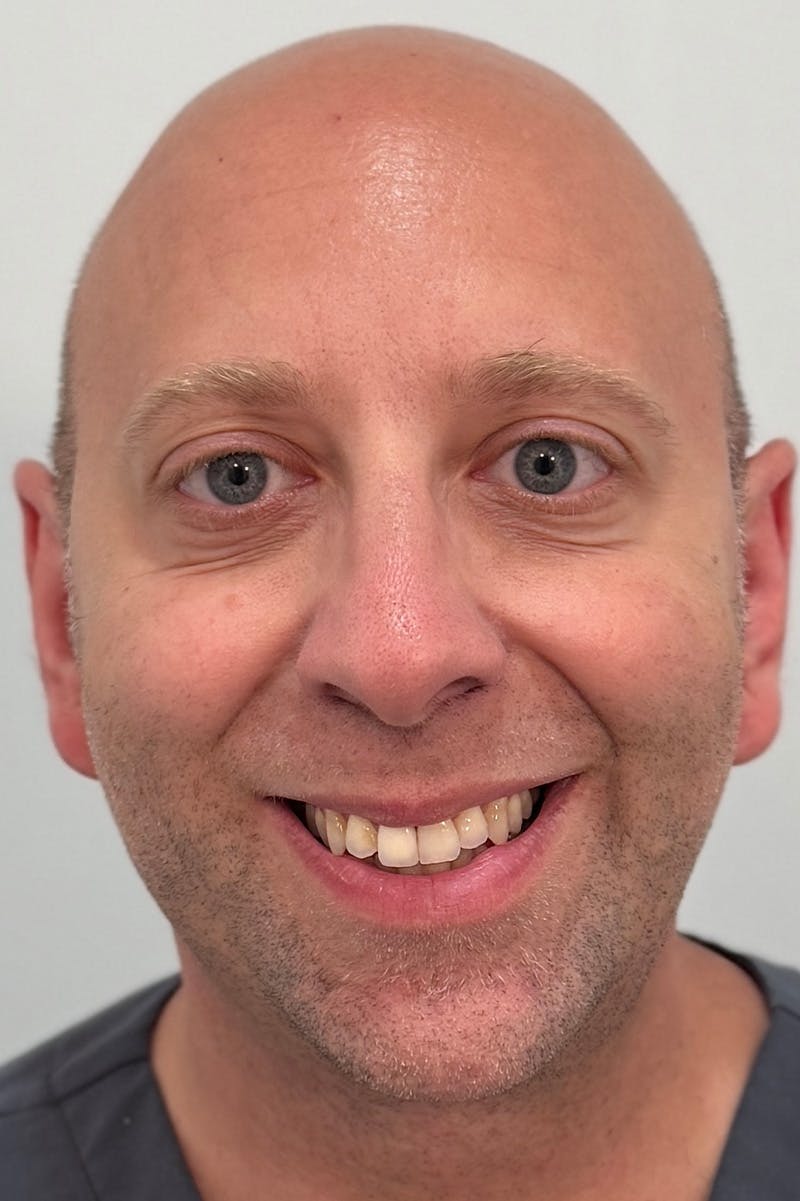 Injectables Before & After Gallery - Patient 235735 - Image 4
