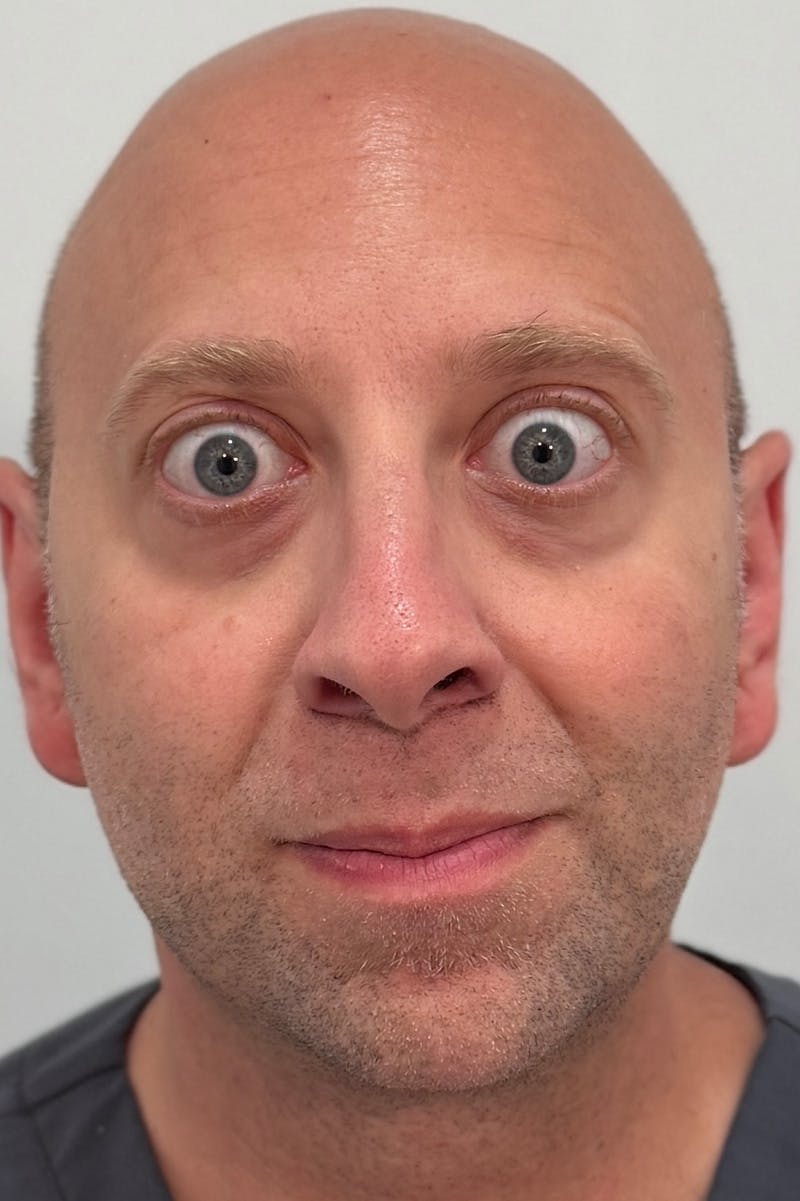 Injectables Before & After Gallery - Patient 235735 - Image 6