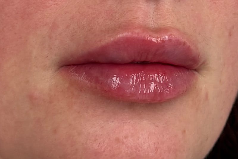 Injectables Before & After Gallery - Patient 731623 - Image 2
