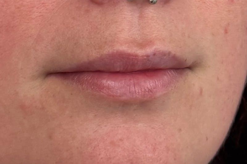Injectables Before & After Gallery - Patient 731623 - Image 1