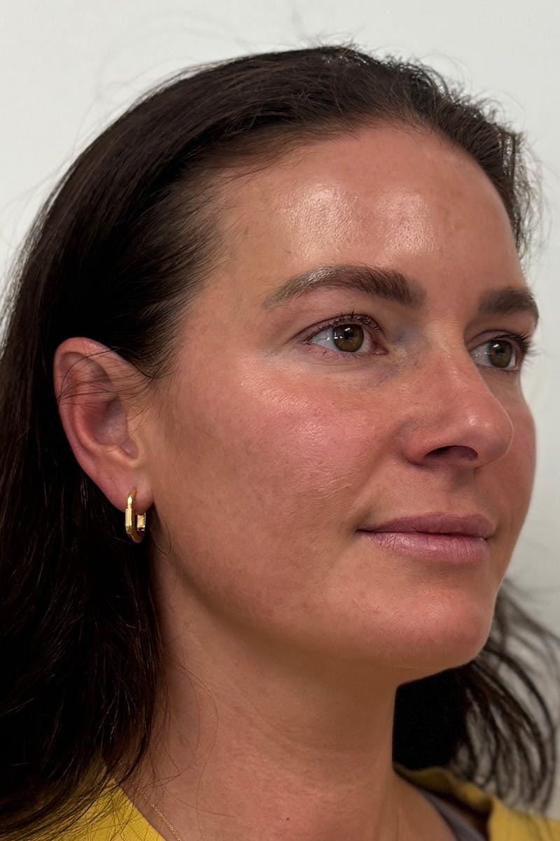 Injectables Before & After Gallery - Patient 382790 - Image 2