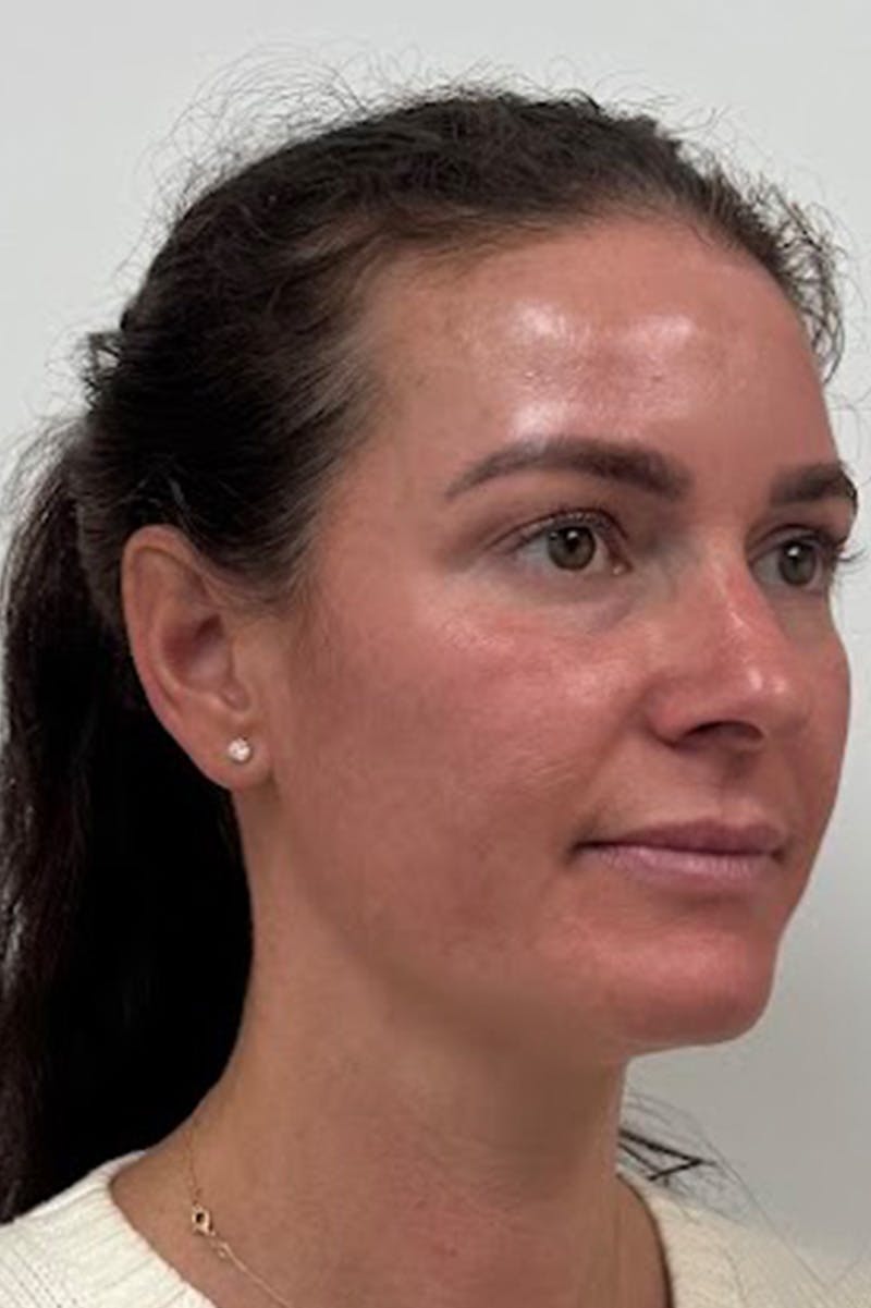 Injectables Before & After Gallery - Patient 382790 - Image 1