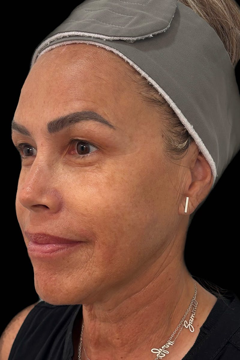 Injectables Before & After Gallery - Patient 339565 - Image 2
