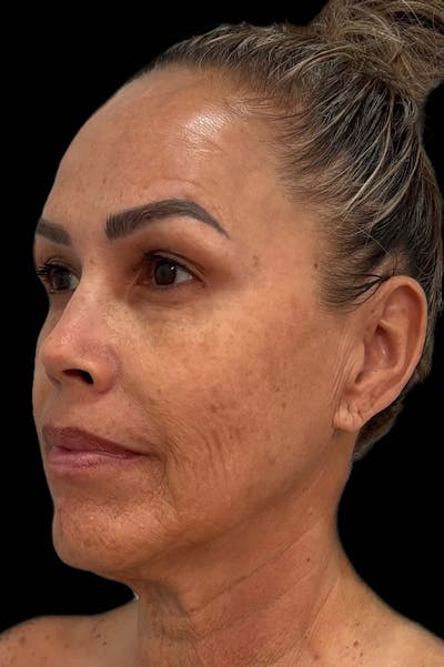 Injectables Before & After Gallery - Patient 339565 - Image 1