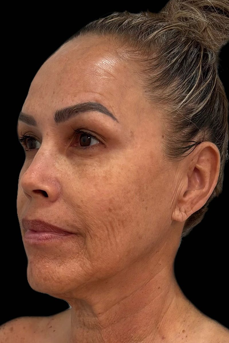 Injectables Before & After Gallery - Patient 339565 - Image 1