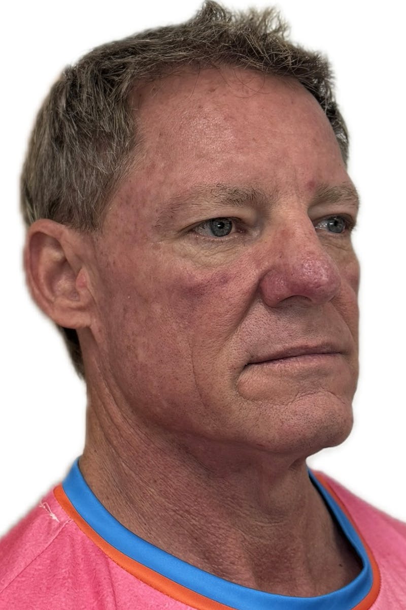 Injectables Before & After Gallery - Patient 219770 - Image 1