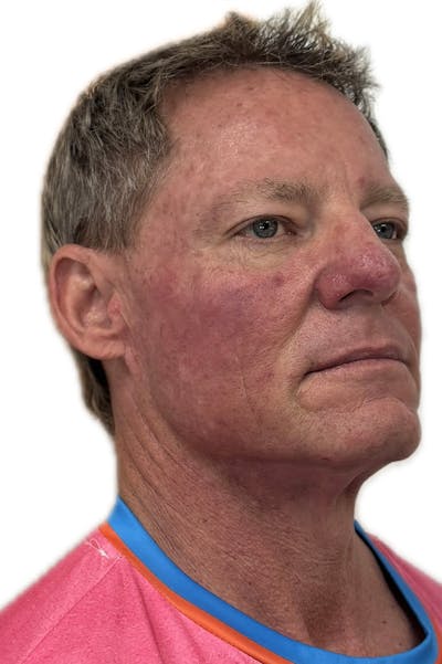 Injectables Before & After Gallery - Patient 219770 - Image 2