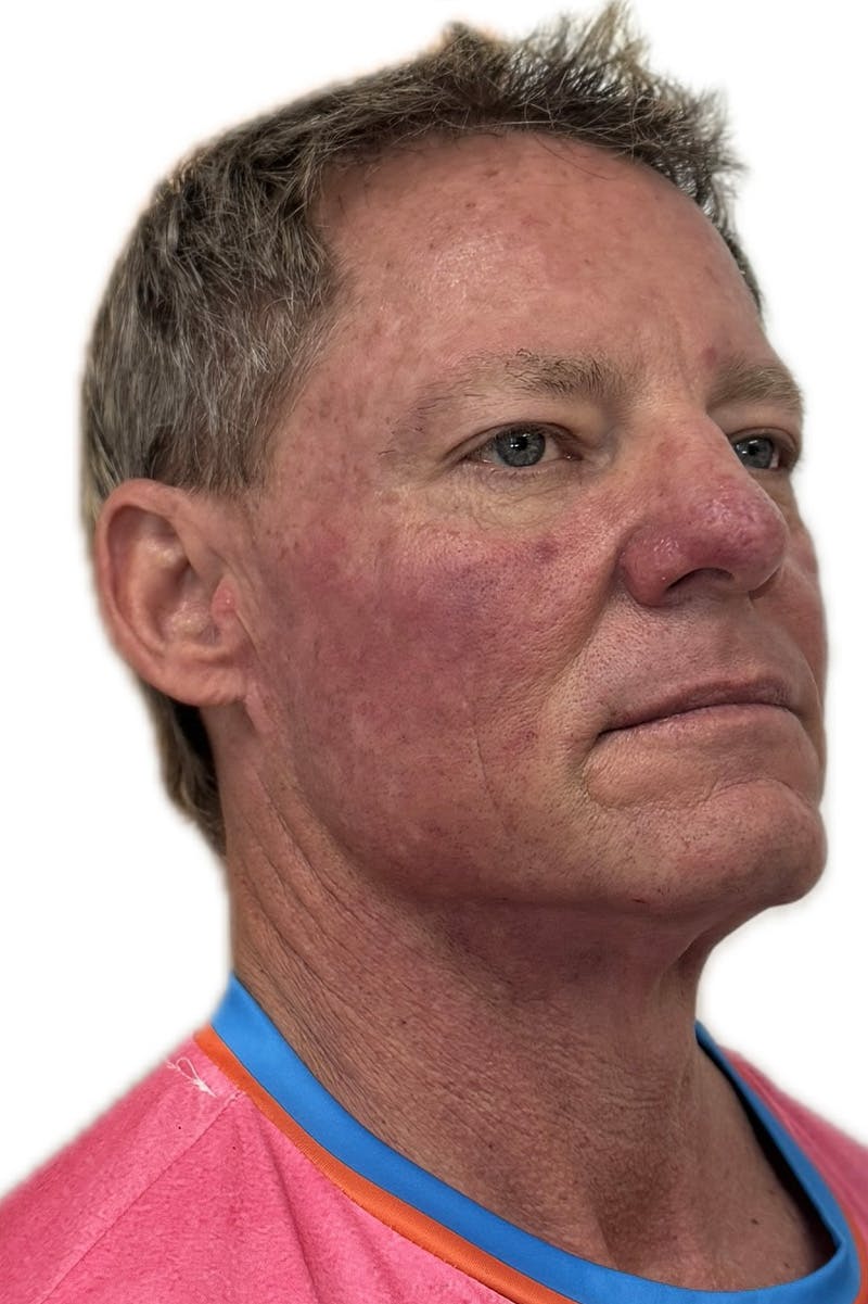 Injectables Before & After Gallery - Patient 219770 - Image 2