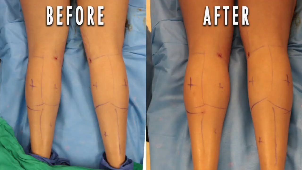 Calf augmentation results