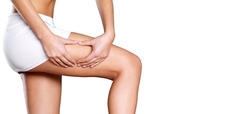 close up of a woman's thigh in white shorts displaying fat on her thigh