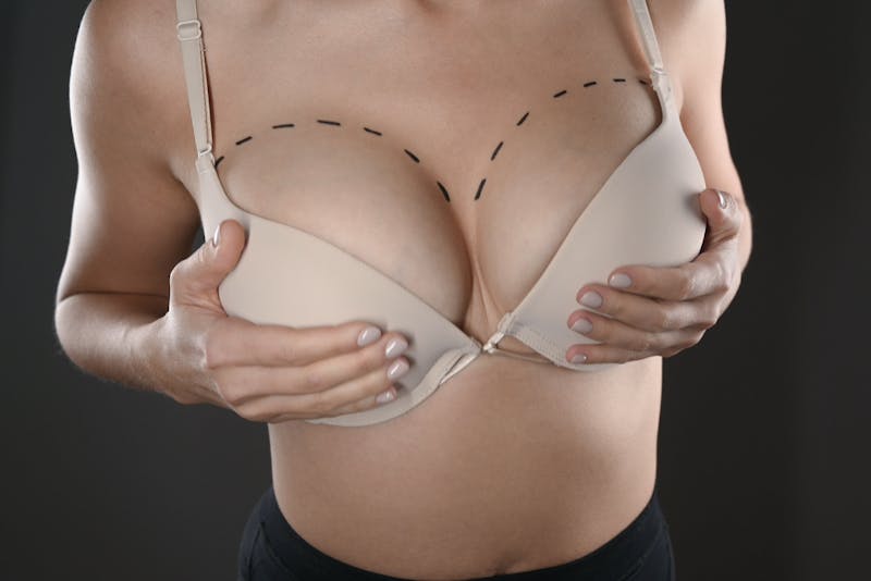 Fat Transfer For Breast Augmentation: Pros And Cons - Leif Rogers MD