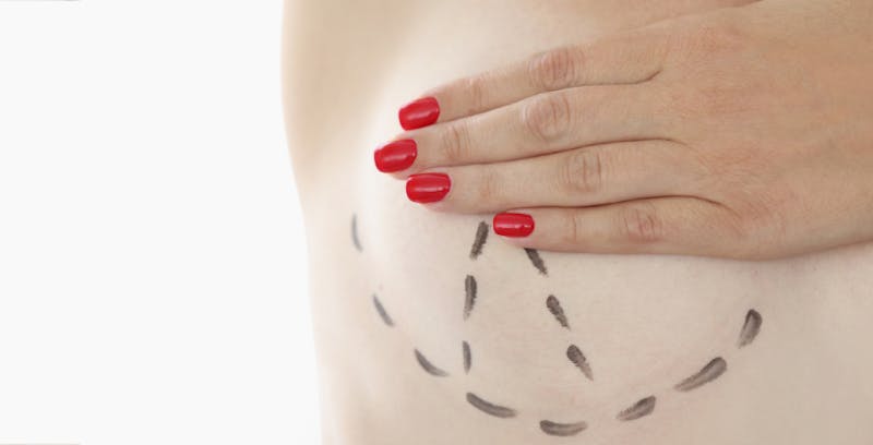 close up of woman's breast with hand covering and dotted lines drawn on