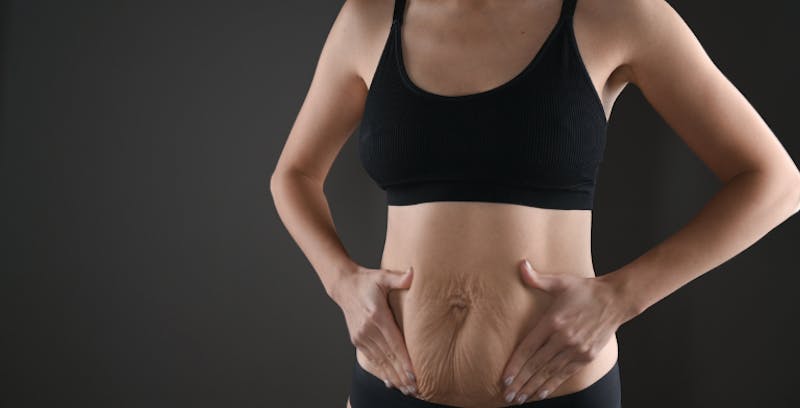 Woman with loose abdominal skin