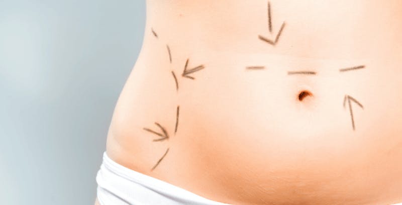 Woman's abdomen with incision directions drawn on