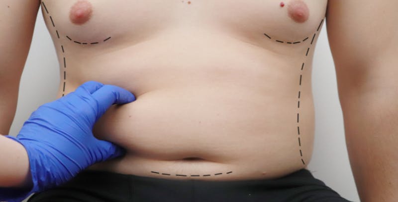 close up of a doctor with a blue glove examining man's stomach