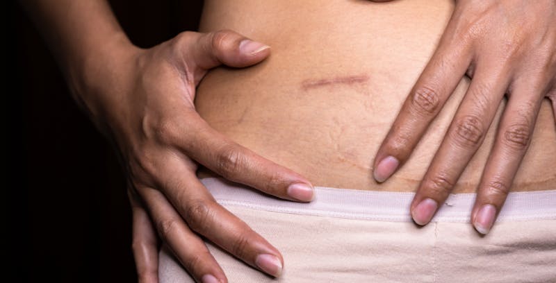 close up of woman's hands on their waist around a scar