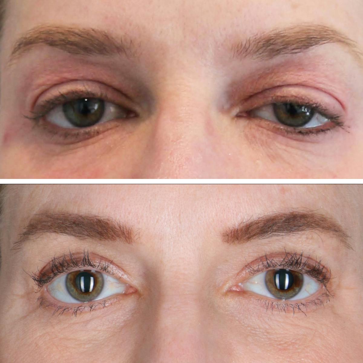 Eyelid Lift Before & After Gallery - Patient 177934063 - Image 1