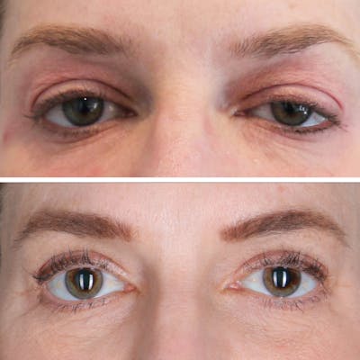 Eyelid Lift Before & After Gallery - Patient 177934063 - Image 1