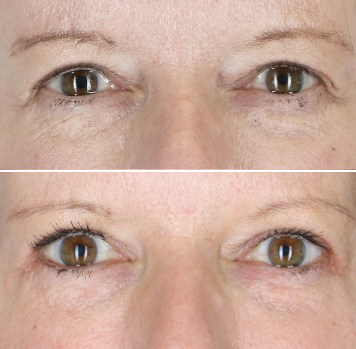 Eyelid Lift Before & After Gallery - Patient 177934064 - Image 1