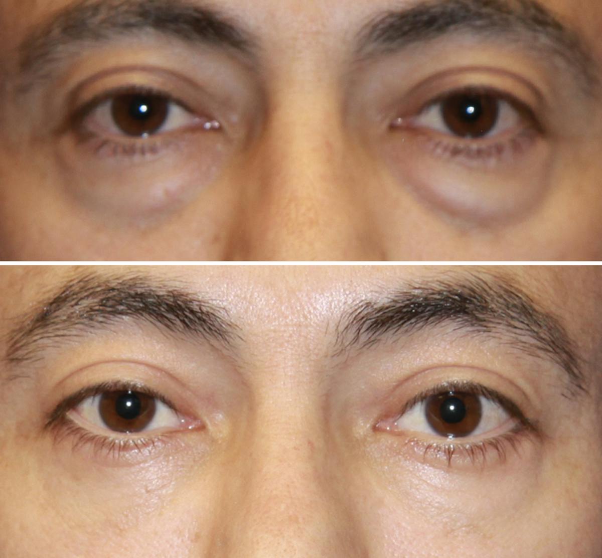 Eyelid Lift Before & After Gallery - Patient 177934065 - Image 1