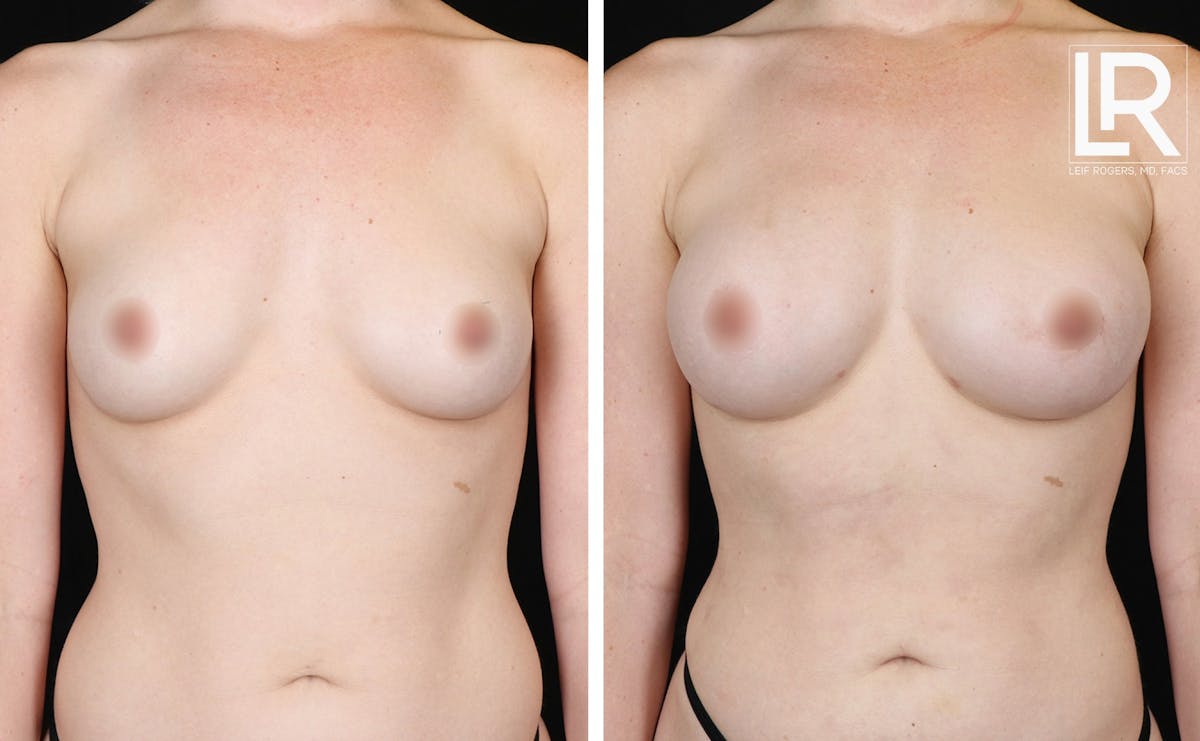 Breast Augmentation Before & After Gallery - Patient 177943222 - Image 1