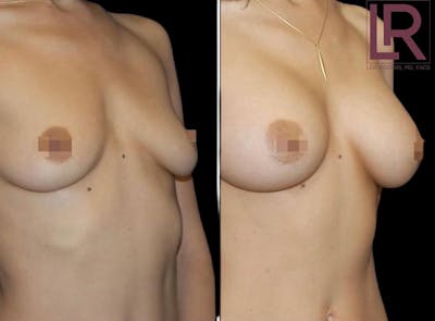 Breast Augmentation Before & After Gallery - Patient 177943225 - Image 1