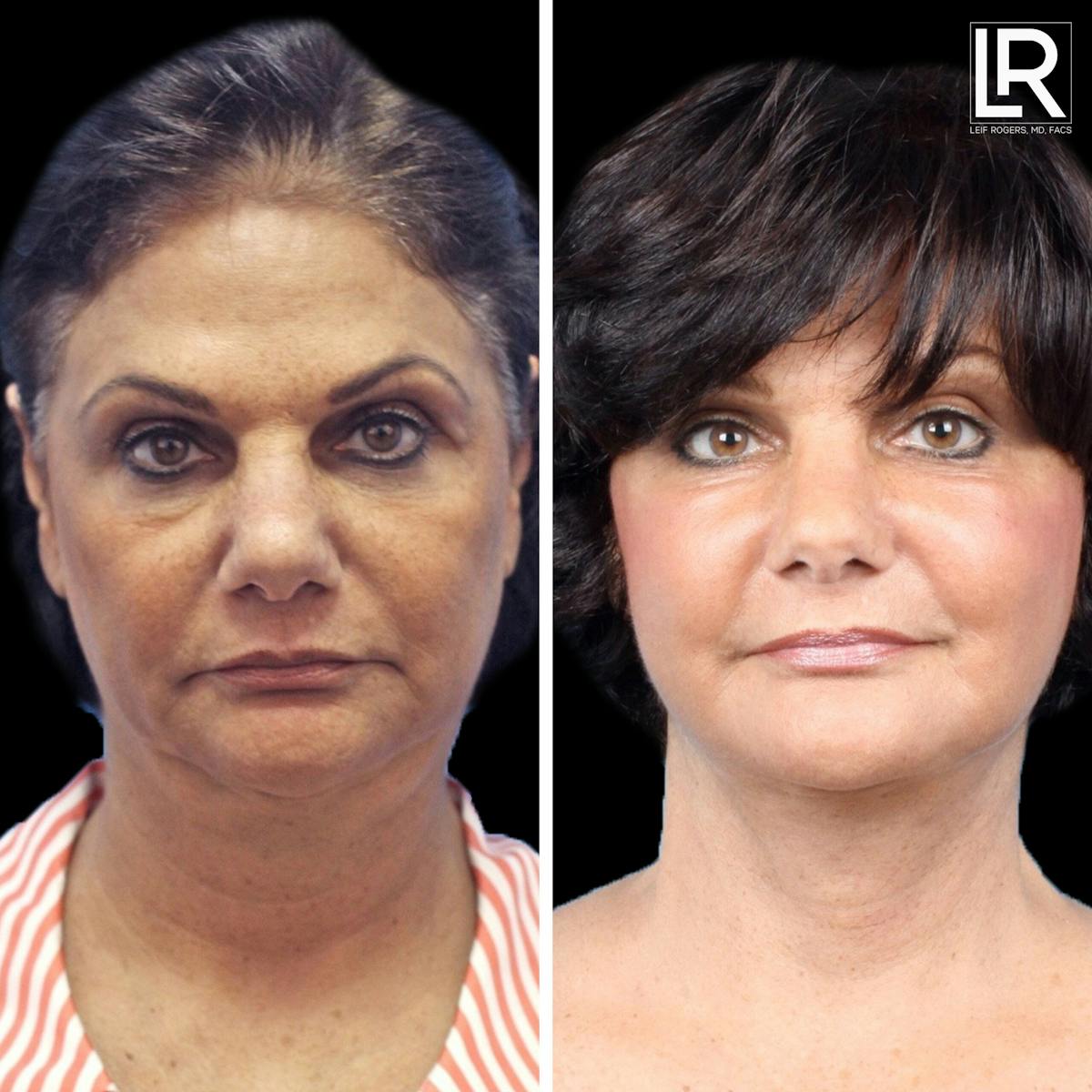 Facelift Female Before & After Gallery - Patient 177944014 - Image 1