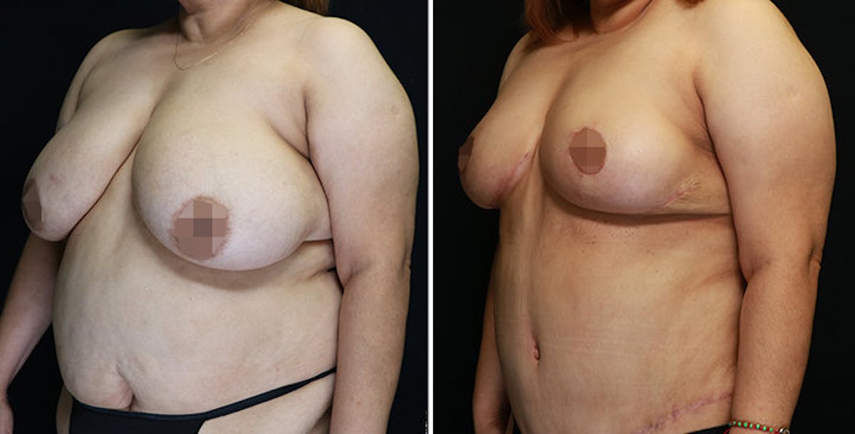 Mommy Makeover Before & After Gallery - Patient 177944033 - Image 3
