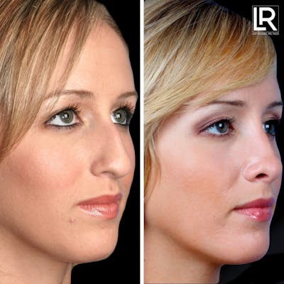 Rhinoplasty Before & After Gallery - Patient 177944583 - Image 1