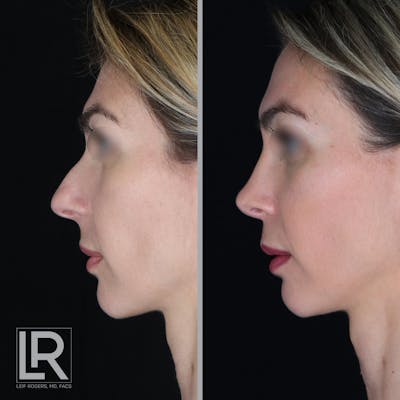 Rhinoplasty Before & After Gallery - Patient 177944584 - Image 1