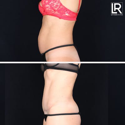 Tummy Tuck Before & After Gallery - Patient 177944623 - Image 1