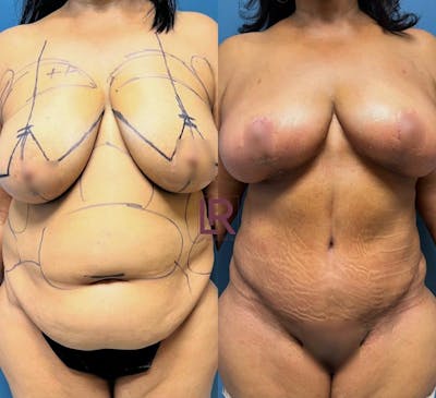 Tummy Tuck Before & After Gallery - Patient 177944626 - Image 1
