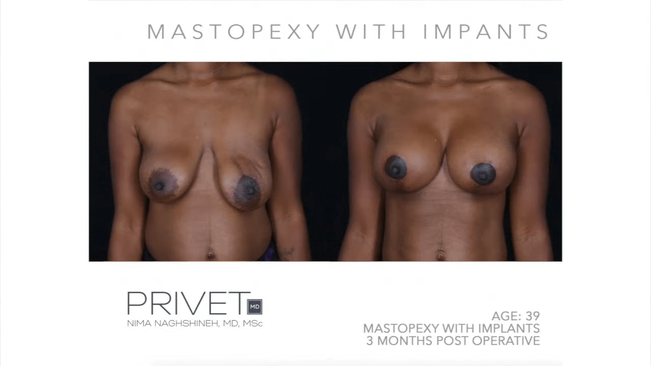 Mastopexy results