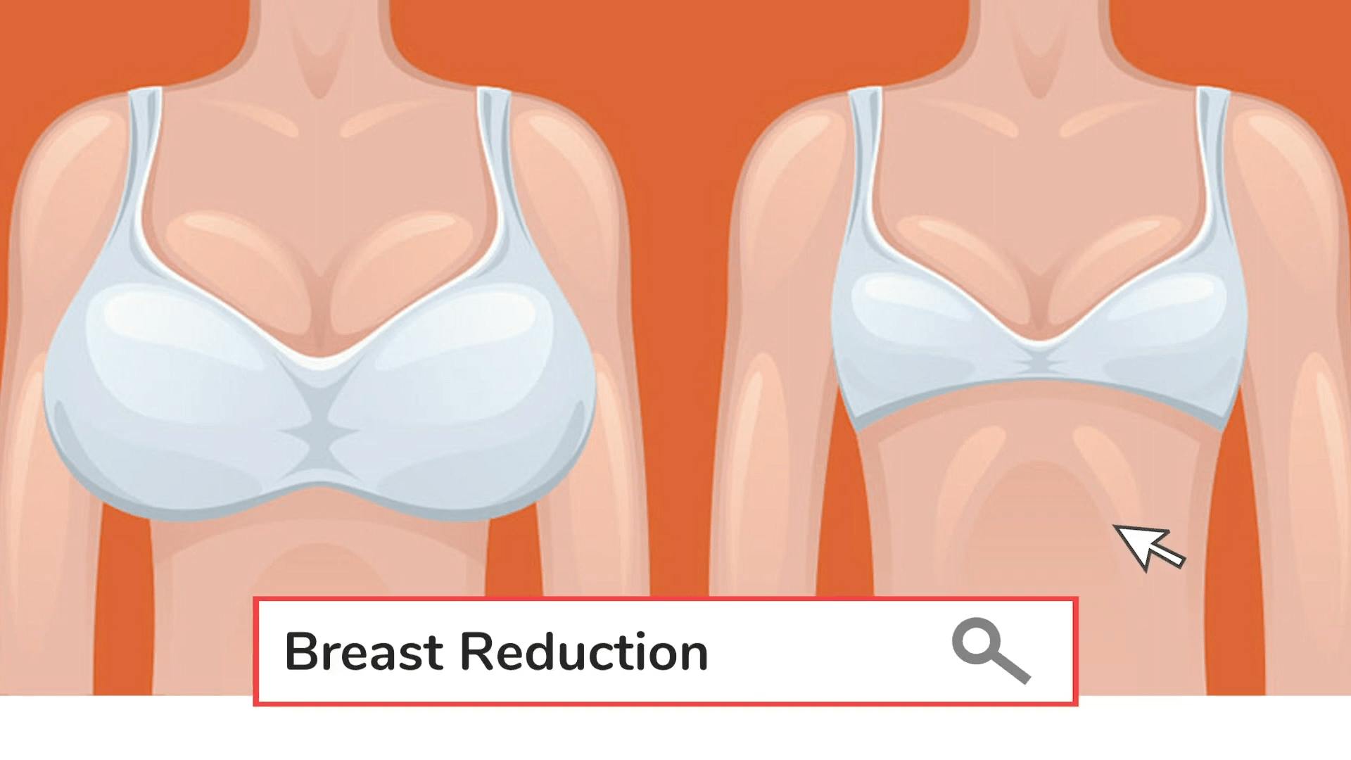 Breast reduction infographic