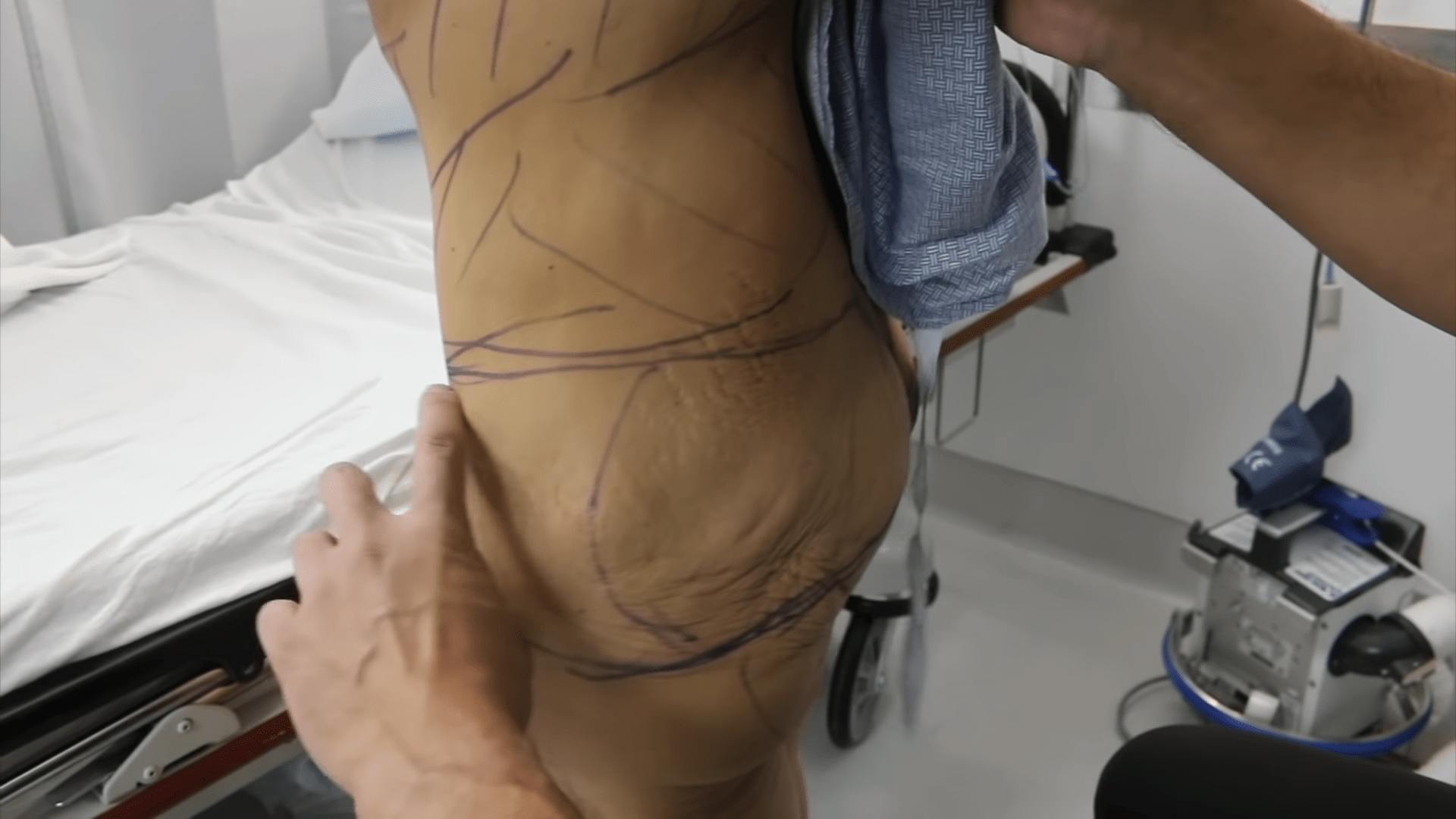 Patient preparing for plastic surgery after massive weight loss