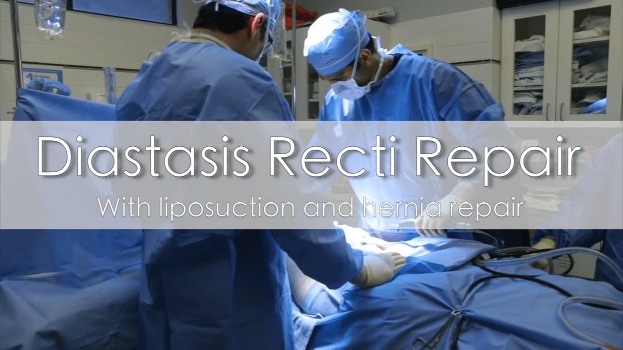 Diastasis recti repair surgery